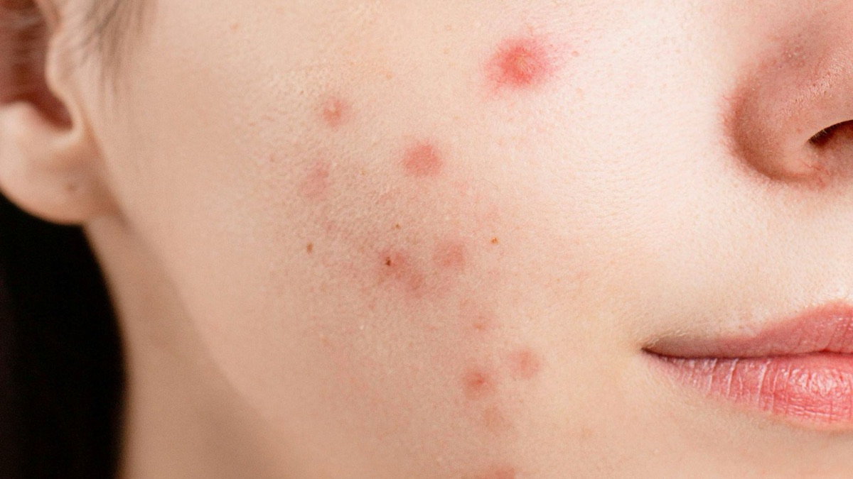 5 At-Home Remedies For Breakouts